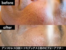 ヘアーアンドエステ ハラダ 滝ノ水店/アンストレス3+コモデックス1