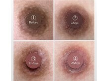 バイミュリーでメラニンケア★ローマピンクのあとにも◎