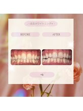 プラスビー 2号店(+b)/ホワイトニングビフォーアフター