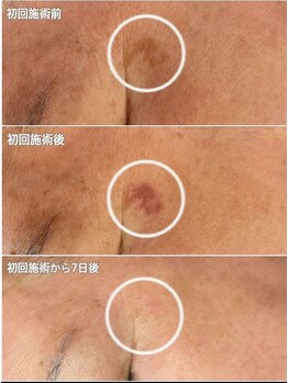 ジャスミントの写真/長年悩んだお肌のお悩みにシミケアコース！韓国初最新光美容機器で、透明感あふれる素肌へ
