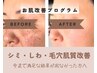【フェイシャル/シミ集中改善】本気で改善したい方のためのカウンセリング