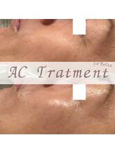 エステティックサロン ラ ベルタ(Esthetic Salon La Belta)/ACトリートメント1回