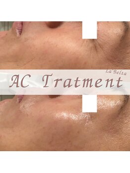 エステティックサロン ラ ベルタ(Esthetic Salon La Belta)/ACトリートメント1回