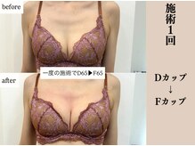 ソワ(soie)の雰囲気（30代前半/出産経験あり/一度の施術/デコルテ/下垂/産後/ハリ）