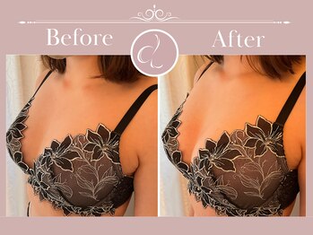 美バストアルファ(美bust α)/【バストアップ】症例