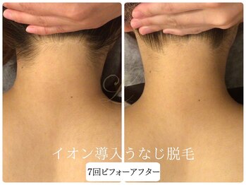 リノ(Lino)/うなじ脱毛シェービング付き♪