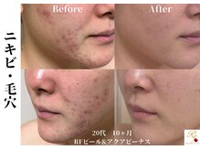 ローズフィールド(Rosefield)/RFピール/ニキビ/シミ/毛穴