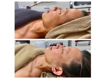 ココ平塚店(COCO)の雰囲気（マイクロリフトbefore→after）