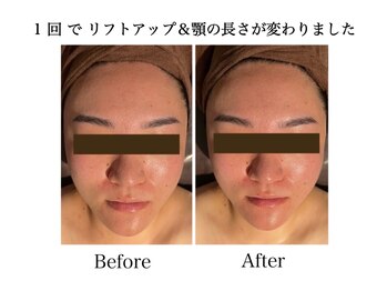 ナチュラーレ 天王寺店(Naturale)/美肌ニキビケア小顔フェイシャル