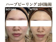 ティアム バイ テトテ 神戸三宮(TIAM by tetote)/ハーブピーリング