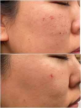 スキンラボ 新宿(@SkinLabo)/大人気【プラズマシャワー】