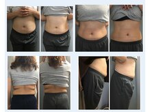 ミロク(369)の雰囲気（脂肪冷却痩身2～3回の結果です。同一箇所は1か月ごとに5回推奨）