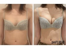 リール 新宿店(RIRE)/20代後半　 バストアップ症例