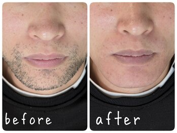 癒し処 ほっこり 海田店/【人気No.1】ヒゲ脱毛/30代