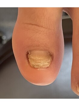 ミヨン 喜多見店(Miyong)/変形爪ケア