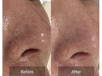 ルシェルブルー(Le ciel bleu)/炎症レス＊毛穴洗浄♪