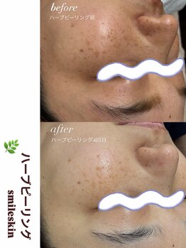 スマイルネイル(SMILE NAIL)/