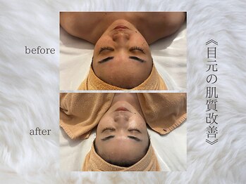 ジュプン 長崎/復元パックで美白ケア！