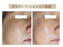 エボルブ 四条烏丸店(EVOLVE)/目元のシワ、たるみ毛穴改善！