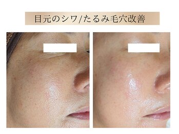 エボルブ 四条烏丸店(EVOLVE)/目元のシワ、たるみ毛穴改善！