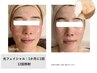 【新規】赤みが気になる肌に◎光フェイシャル＋美肌パック付￥9,900→