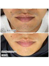 エステ シンセリティー(aesthetic sincerity)/ヒゲ脱毛 10,900円