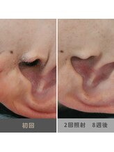 キムラケ 和光別邸(木村家 KIMURAKE)/メンズ脱毛耳毛ビフォーアフター