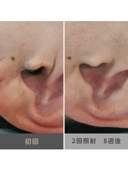 キムラケ 和光別邸(木村家 KIMURAKE)/メンズ脱毛耳毛ビフォーアフター