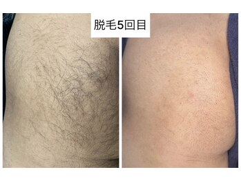 ラウラウ(laulau)/おしり脱毛