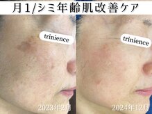 トリニエンス 新宿店(TRINIENCE)/60代/シミケア/肌代謝ケア