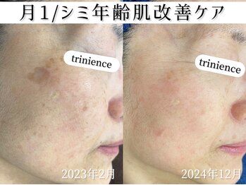 トリニエンス 新宿店(TRINIENCE)/60代/シミケア/肌代謝ケア