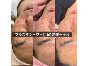 アースコアフュールボーテ 佐野新都市店(EARTH coiffure beaute)/【プラズマ】Before/After