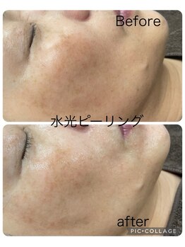 ルミネル 名古屋新栄(Luminelle)/水光ピーリング