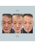 【ダブル1ヶ月以内の再来店】”育てる美容”エクソリフトメンテナンス45分