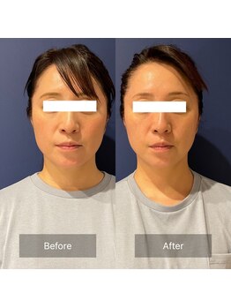 フフラ KANコルギセラピー山梨本店(fufla)/小顔ソムリエ