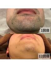 セイリキ(SEIRIKI)/男性ひげ脱毛