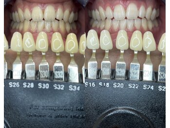 トウキョースワーズ 渋谷店(TOKYO SWRS)/#ホワイトニング #渋谷 #池袋