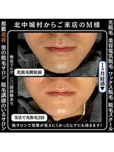 メンズディースタイル 北谷店(Men's Dstyle)/北谷メンズ脱毛ヒゲBefore after