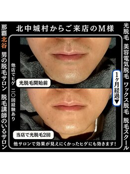 ディースタイル 北谷店(Dstyle)/北谷メンズ脱毛ヒゲBefore after