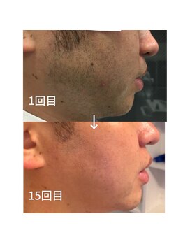 アサラク/ヒゲ脱毛