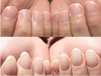 セラキュアネイル(Theracure nail)の写真/【深爪・反り爪改善／巻き爪矯正／美爪ケア】解決・緩和・育成を美爪クリエイターがお手伝いたします＊