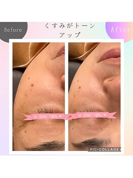 パルティノ 高崎店/光エステ・毛穴開き・シミケア・