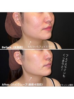 ミエル 神戸店(Miel)/HIRFWAVEハイアールエフウェーブ