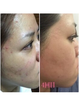 ティエット(tiet)/ハーブピーリング