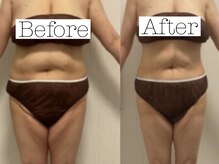 ホリスティックラボ(Holistic Labo)/Before & After (お腹)