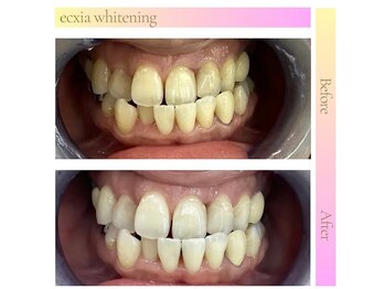 エクシアホワイトニング 明石店/ホワイトニング体験/記念写真