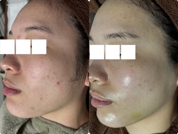 リボーン(REBORN)/ハーブピーリング