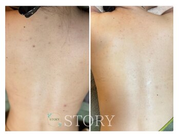 ストーリー(STORY)/ハーブピーリング専門店STORY