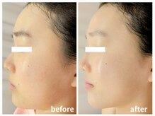 ラミーユ(La Miu)/【一度の施術の変化】