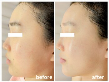 ラミーユ(La Miu)/【一度の施術の変化】